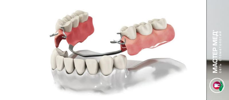 Бюгельный протез – лучший вариант среди съемных зубных конструкций