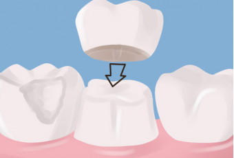 Металлокерамические коронки - лучшее решение для протезирования зубов в любом возрасте