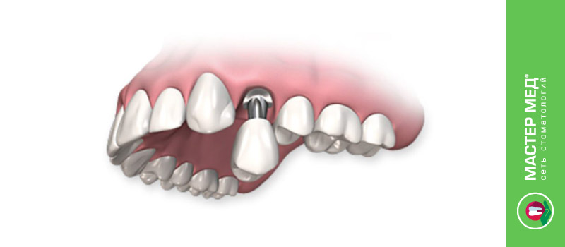 Зубные импланты последнего поколения: что это означает для пациента