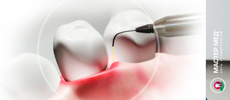 Особенности лазерной имплантации зубов
