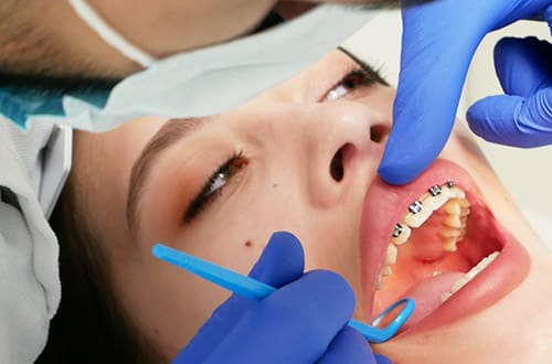Вирівнювання зубів