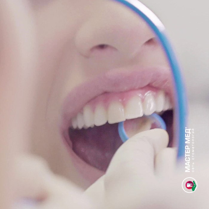 Шлифовка шероховатостей после зубной чистки